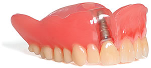 Zahn-Implantat mit Krone (Zahnwurzel aus Titan)