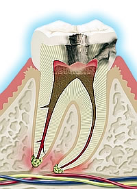 Entzündliche Zahnwurzel